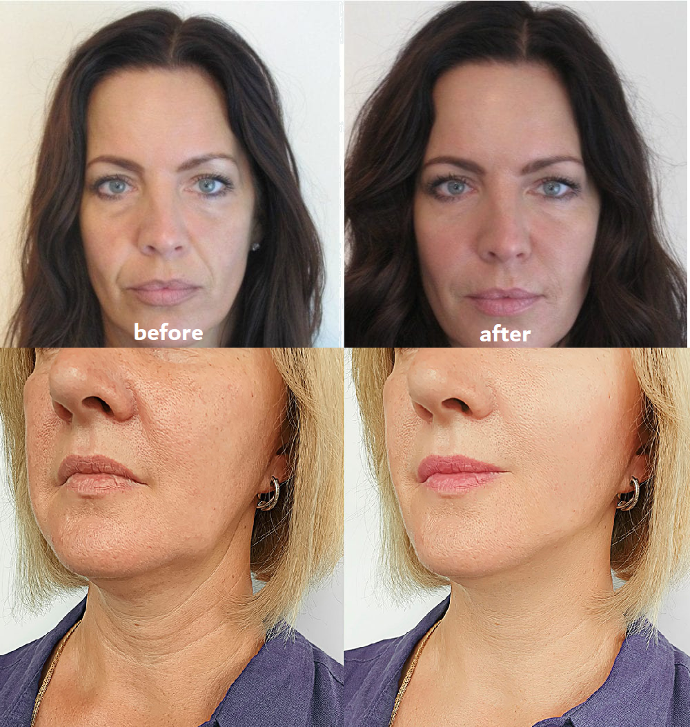 Wrinkle Reduction Pads