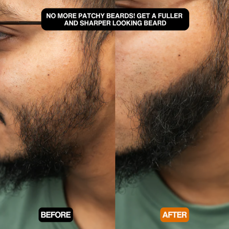 Quick Solution for a Natural, Voluminous Hairline