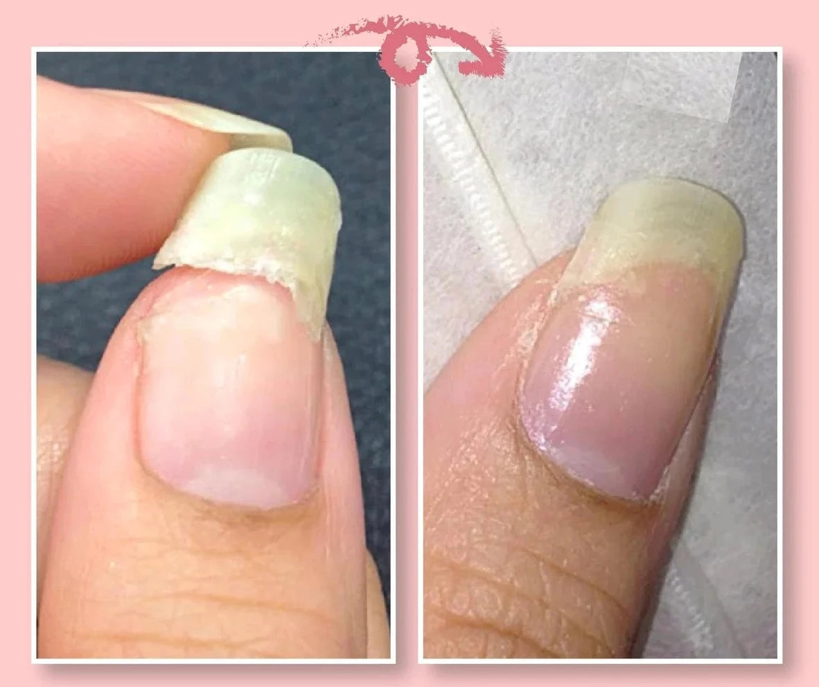 Nail Repair Solution for Damaged Nails