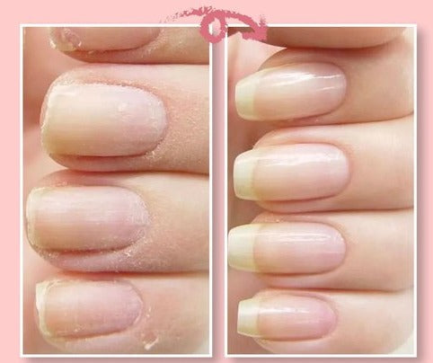 Nail Repair Solution for Damaged Nails