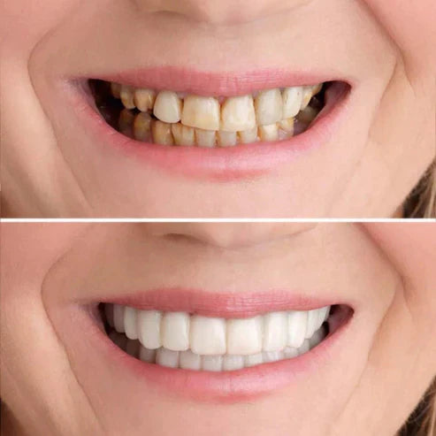 Thermo-Adjustable Smile Cover for an Instant Even Appearance