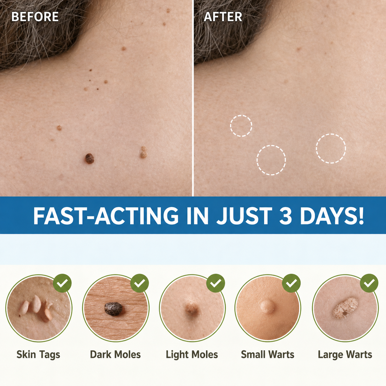 Skin Tag Removal Patch | Natural & Pain-Free Label Remover