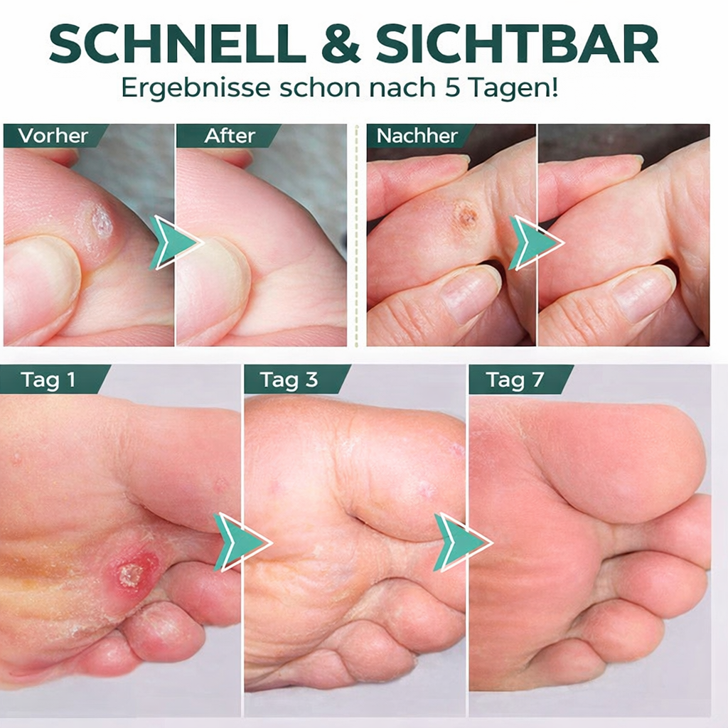 Callus Remover with Precision Applicator for Strong Results