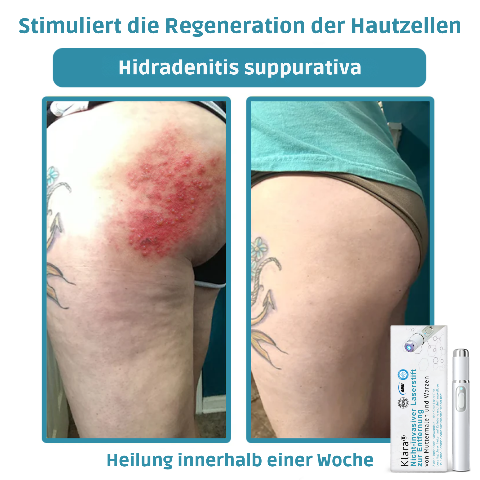 Painless Laser Pen for Flawless Skin and Confidence Anytime