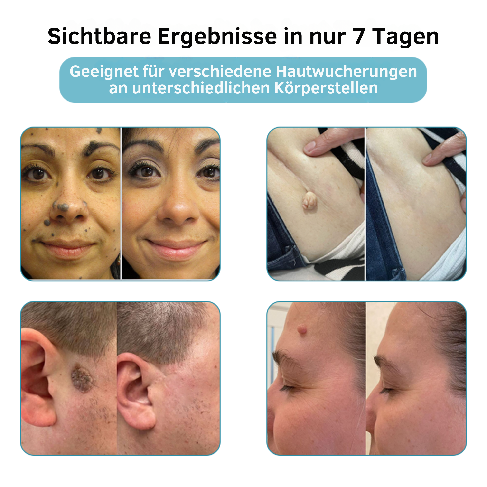Painless Laser Pen for Flawless Skin and Confidence Anytime