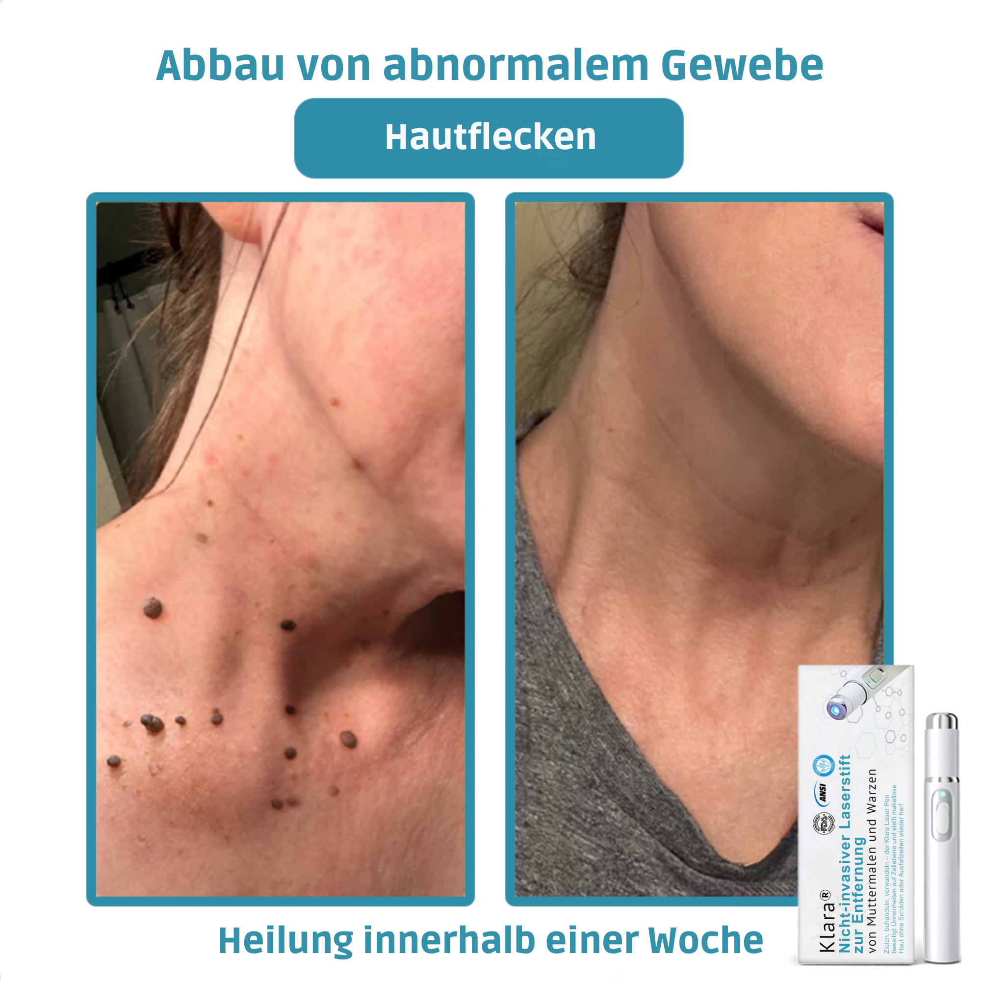 Painless Laser Pen for Flawless Skin and Confidence Anytime
