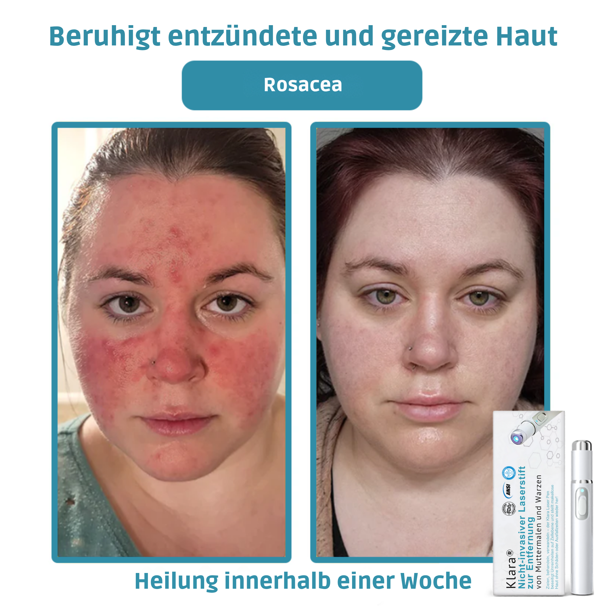 Painless Laser Pen for Flawless Skin and Confidence Anytime