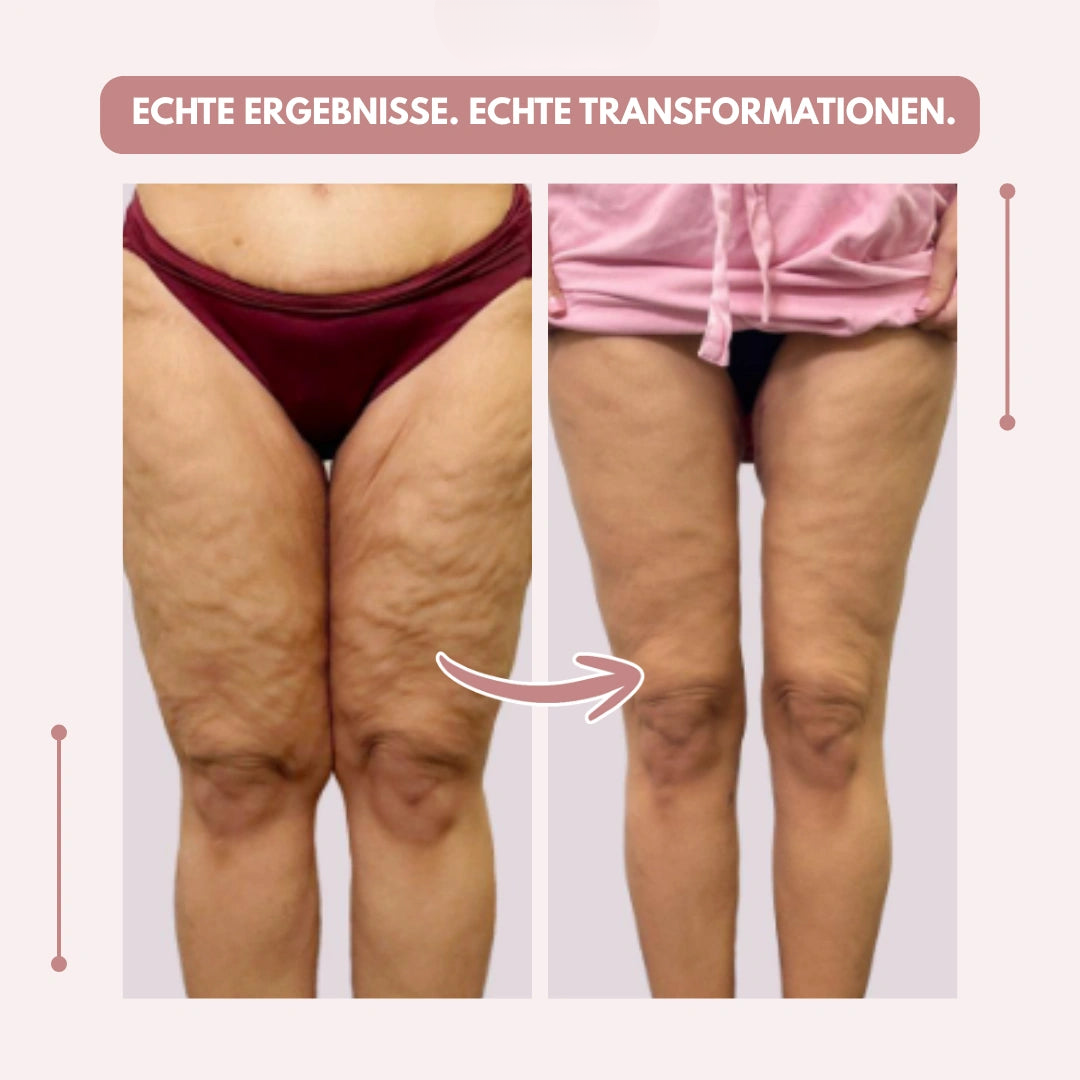 High-Waisted Compression Leggings for Lipoedema Pain Relief