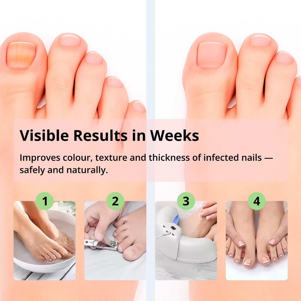 Home Use Laser Nail Treatment Device with Auto Shut-Off