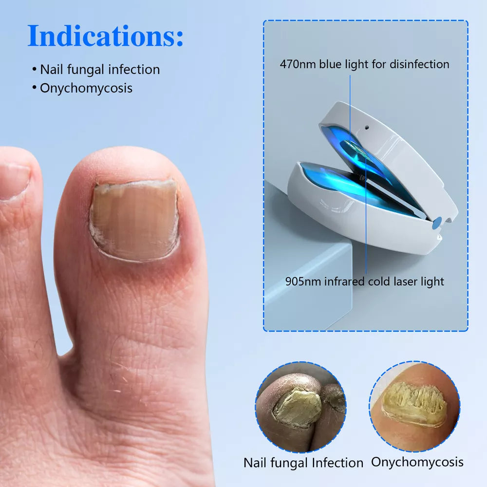 Effective Laser Treatment Device for Nail Fungus Relief