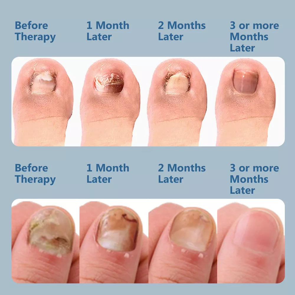 Effective Laser Treatment Device for Nail Fungus Relief