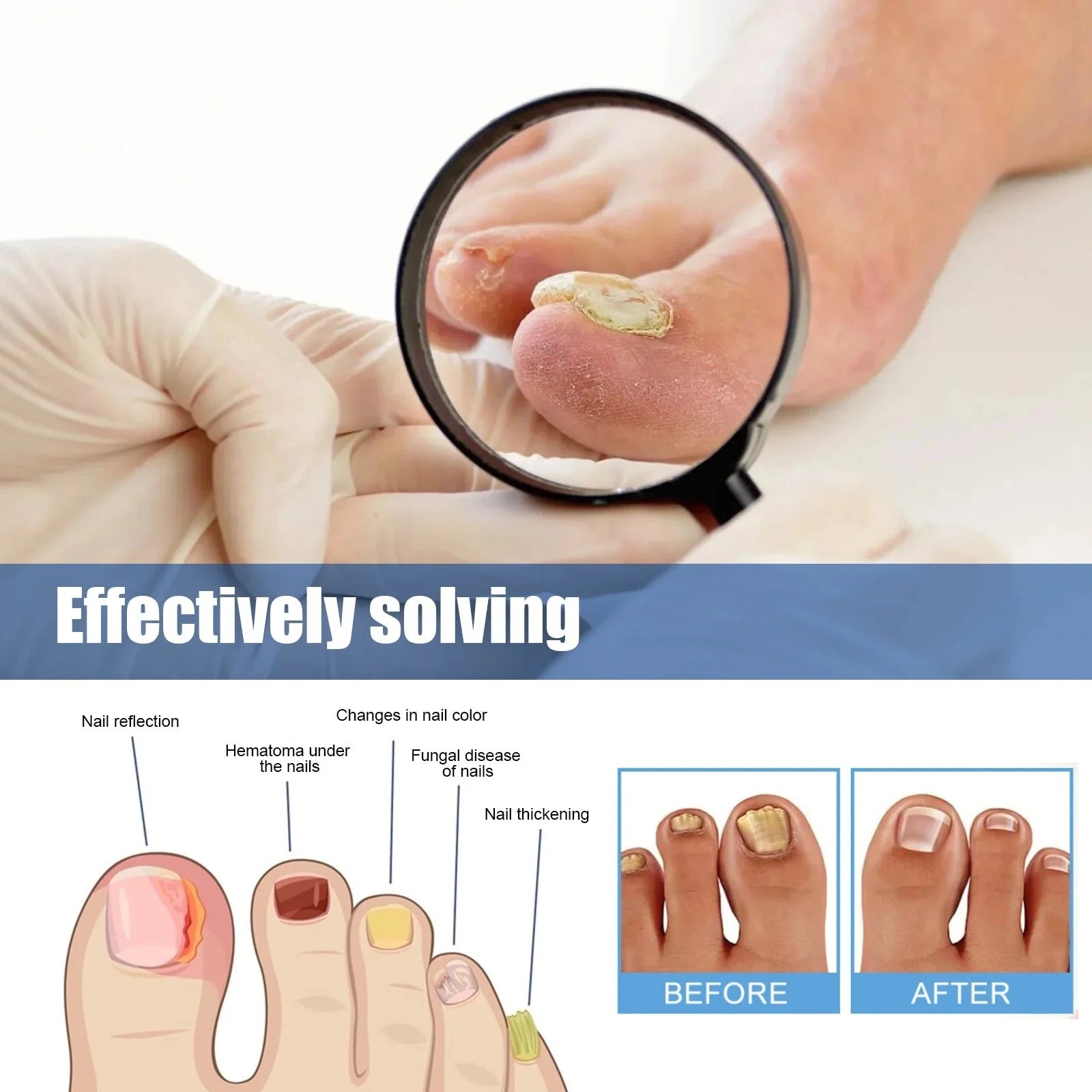 Nail Fungus Treatment Patch | Overnight Care | Regenerating Formula
