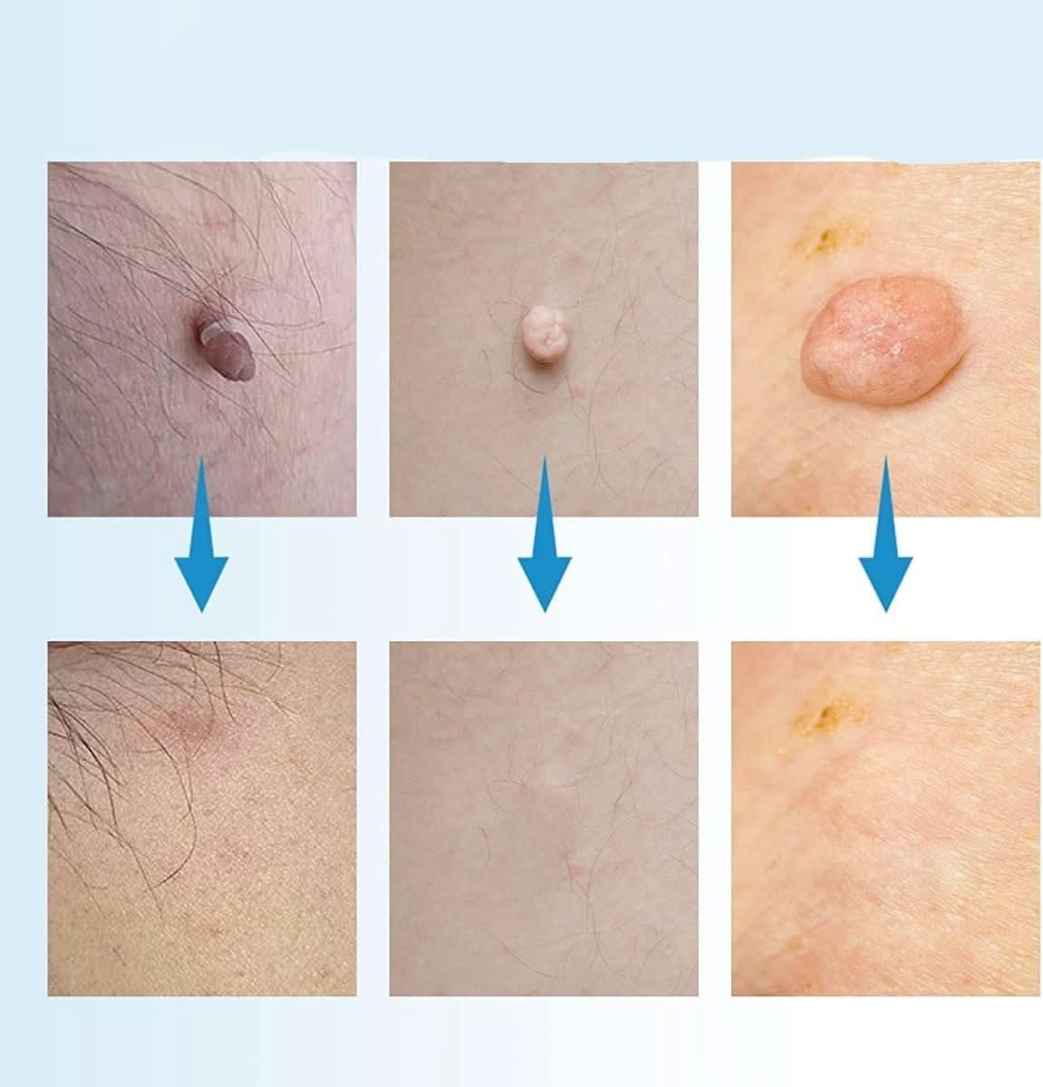Skin Spot Remover Tool for Easy Application
