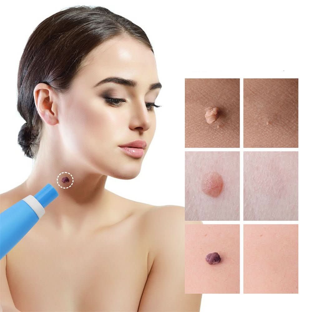 Skin Spot Remover Tool for Easy Application