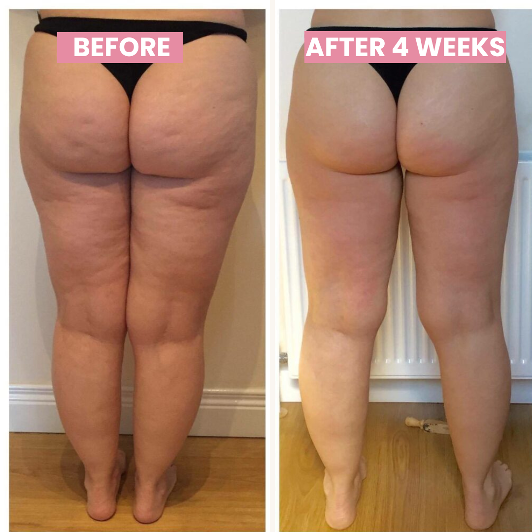 Revitalize Your Skin: Anti-Cellulite Cupping Device with Heat Therapy