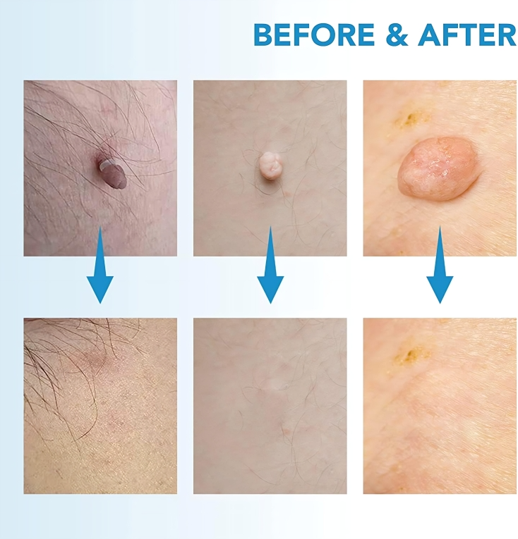 Quick and Safe Removal of Skin Tags