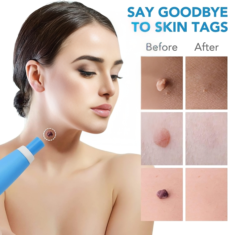 Quick and Safe Removal of Skin Tags