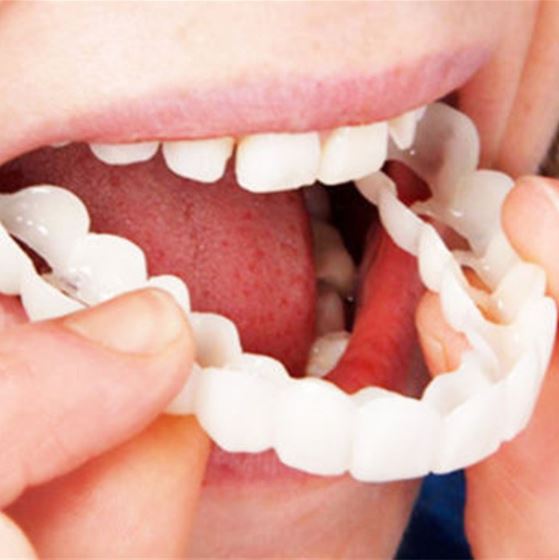Flexible Fit Veneers without Adhesive for Eating, Drinking, and Daily Use