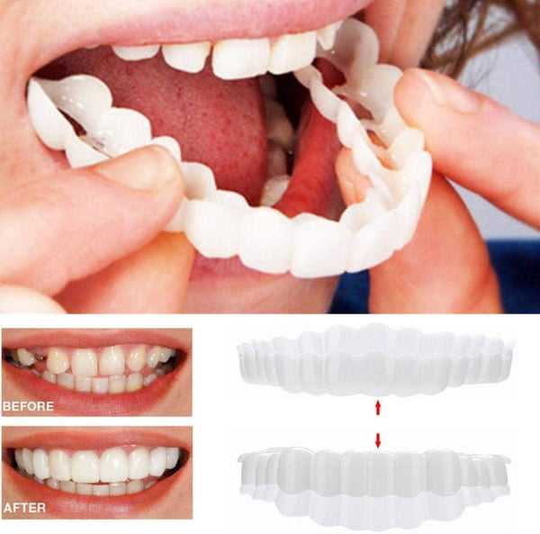 Ultra-Thin Acrylic Resin Veneers for Instant Smile Transformation