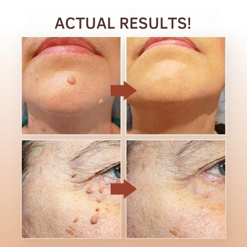 Wart Remover with Precision Applicator for Targeted Treatment – Herbal Formula