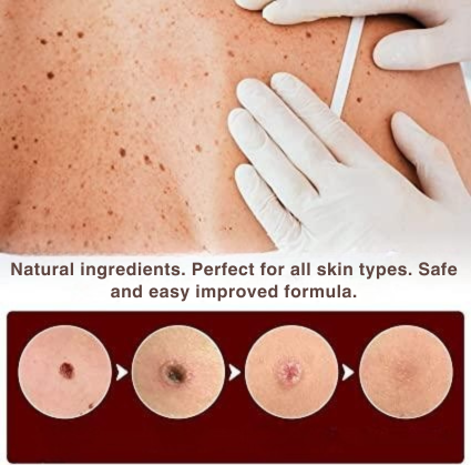 Wart Remover with Precision Applicator for Targeted Treatment – Herbal Formula