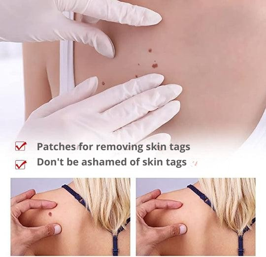 Wart Remover with Precision Applicator for Targeted Treatment – Herbal Formula