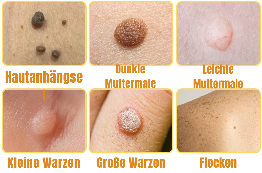 Wart Removal Spray with Bee Venom Formula - Pain-Free Solution