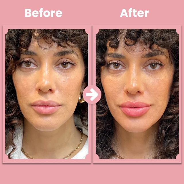 LumaPout™ — Ignite Natural Collagen for Lush, Head-Turning Lips Without Pain