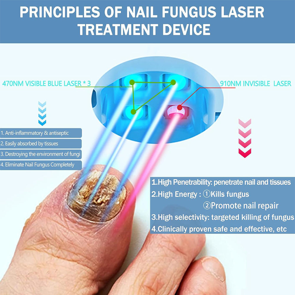 Home Laser Therapy Device for Toenail Fungus Relief