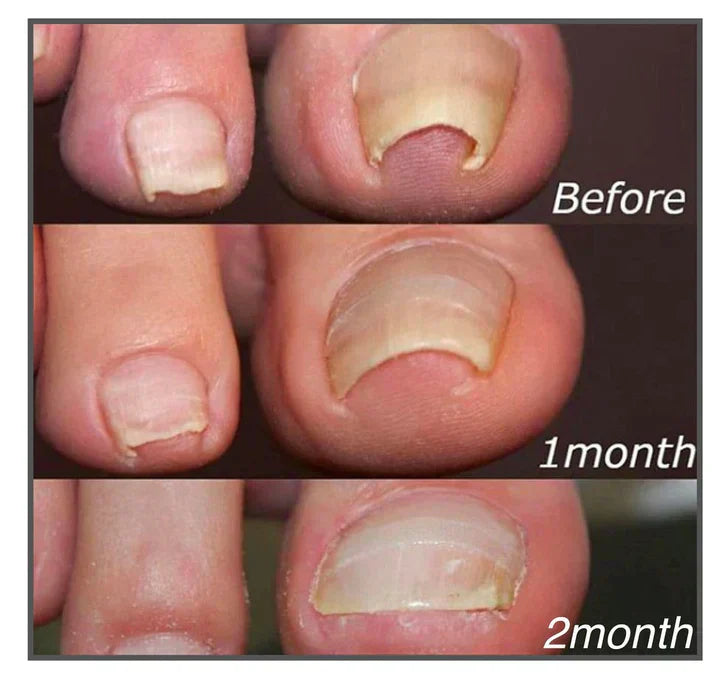 Cutique™ — Step Into Instant Nail Pain Relief and Confidence