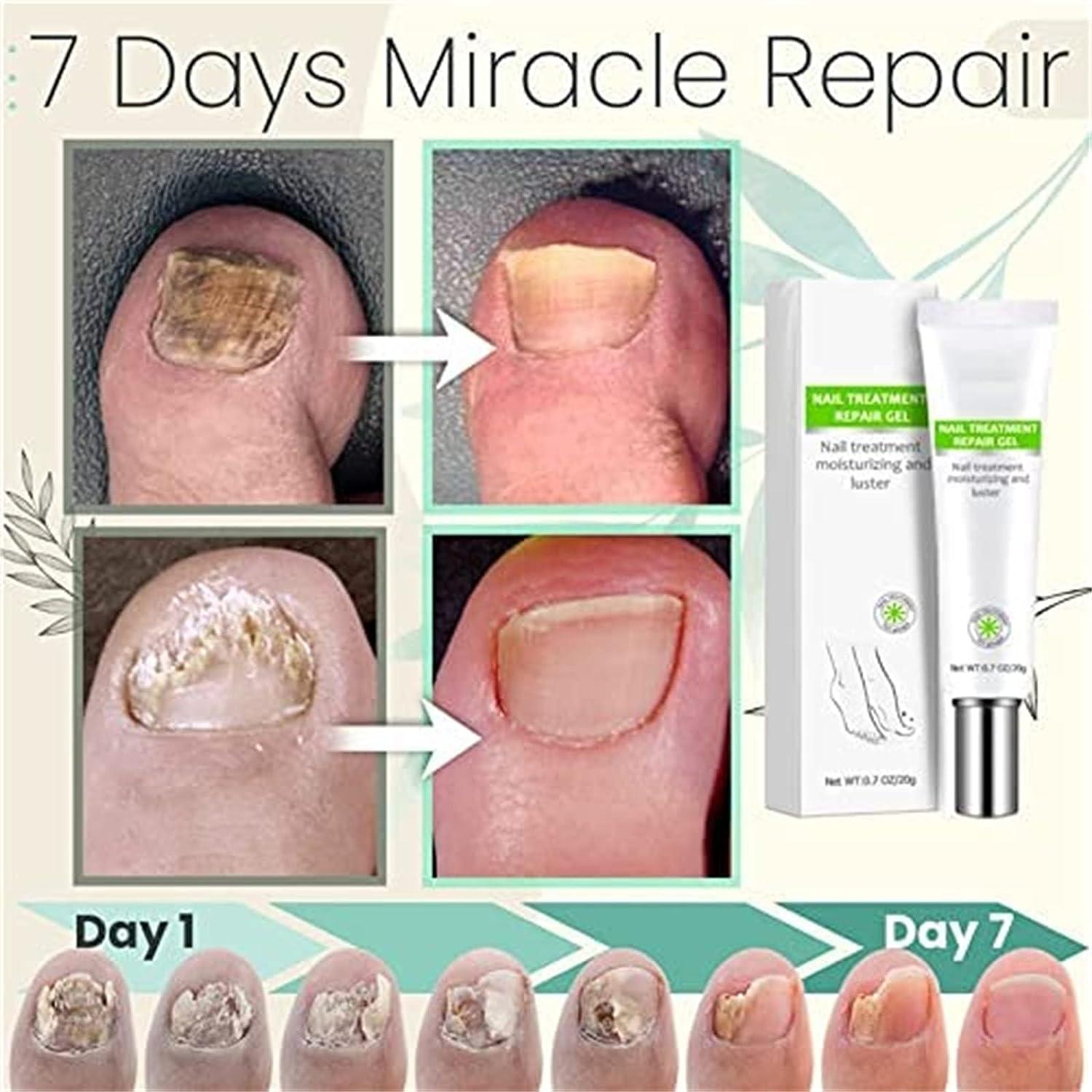 VeraNex™ Repair Gel — Transform Fragile Nails Into Stunning Strength You Can Flaunt