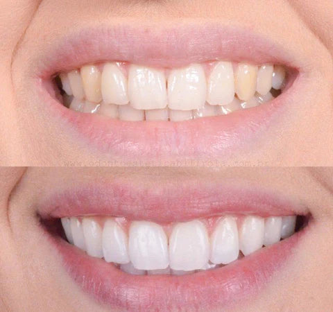 LumaShine™ — Unlock a Radiant Smile That Boosts Your Confidence Instantly