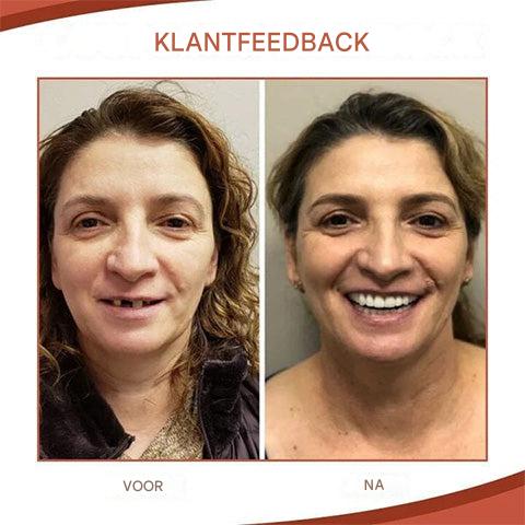 SilkFit™ Denture Comfort Kit — Experience Pain-Free, Perfectly Fitted Dentures That Feel Like Yours