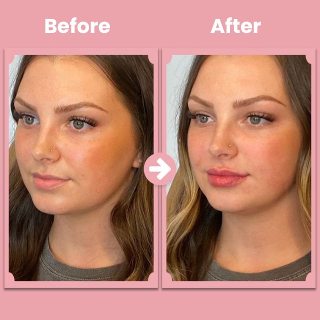 LumaPout™ — Ignite Natural Collagen for Lush, Head-Turning Lips Without Pain
