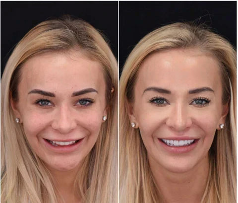 Transform Your Smile Instantly with Custom Fit Veneers