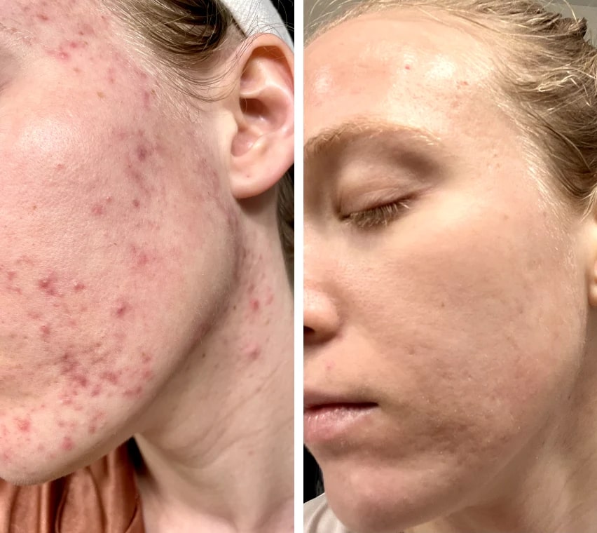 RadiantGlow LED Facial Treatment Mask | Home Light Therapy